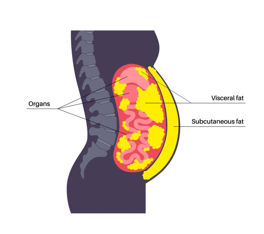 Visceral fat medical poster. Belly fat surrounds internal organs in abdominal cavity. Overweight disease concept. Losing weight, liposuction and diet. Obesity human silhouette flat vector illustration